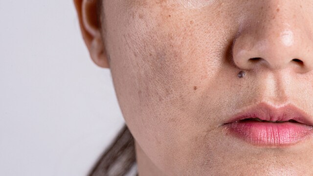 Hormonal imbalances can silently trigger stubborn spots
