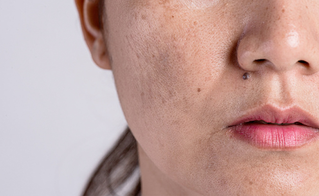 Hormonal imbalances can silently trigger stubborn spots