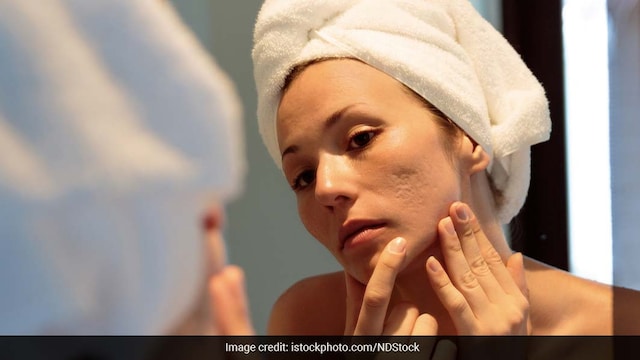 Hormonal imbalances, particularly in women, are key drivers of adult acne