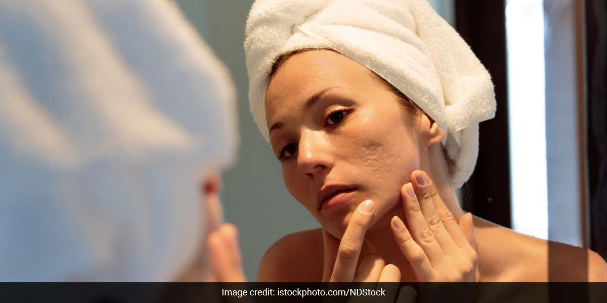 Hormonal imbalances, particularly in women, are key drivers of adult acne