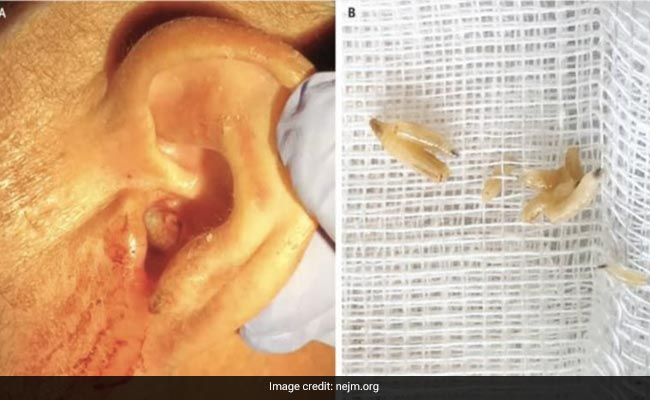 Doctors In Portugal Find Flesh-Eating Maggots Feasting On Man's Eardrum