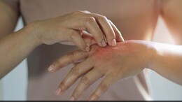 Sick Of Mosquito Bites? Try These Hacks For Relief