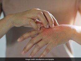 Sick Of Mosquito Bites? Try These Hacks For Relief