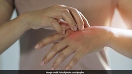 What Is Pollution Rash: Signs And Prevention Tips For Skin Rashes