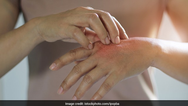 Scratching bites can lead to skin infections, follow these tips to prevent it