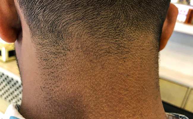 गर्दन का मैल कैसे निकाले