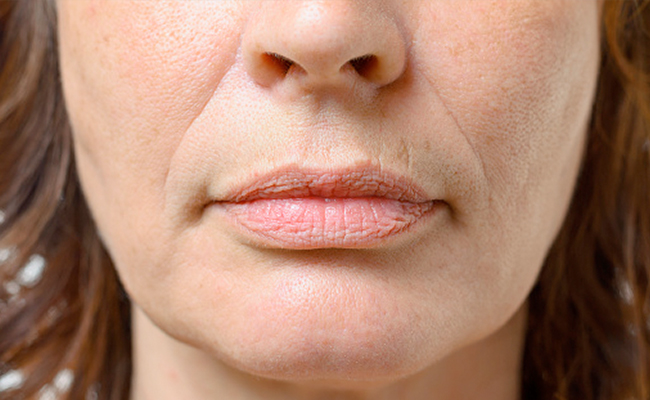 Ozempic Face: While Ozempic can help in weight loss, using without a need comes with serious risks