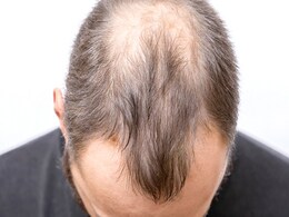 इन 3 गलतियों के कारण झड़ने लगते हैं पुरुषों के बाल, Hair Fall होते-होते दिखने लगता है गंजापन इन 3 गलतियों के कारण झड़ने लगते हैं पुरुषों के बाल, Hair Fall होते-होते दिखने लगता है गंजापन