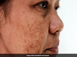 चेहरे पर नजर आने लगी हैं झाइयां, तो इन 6 तरीकों से इन धब्बों को हल्का कर सकती हैं आप चेहरे पर नजर आने लगी हैं झाइयां, तो इन 6 तरीकों से इन धब्बों को हल्का कर सकती हैं आप