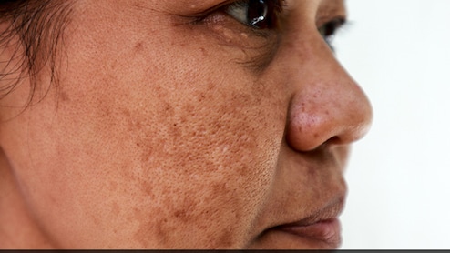 झाइयों से भरा है चेहरा? रमजान में 29 दिन रोजाना लगाएं ये फेस पैक, ईद के दिन चांद पर नहीं आपके चेहरे पर ठहर जाएगी सबकी नजर