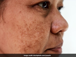 डॉक्टर ने बताया किन चीजों से दूर हो सकती है झाइयों की दिक्कत, अपने खानपान में शामिल कर सकते हैं ये फूड्स  डॉक्टर ने बताया किन चीजों से दूर हो सकती है झाइयों की दिक्कत, अपने खानपान में शामिल कर सकते हैं ये फूड्स