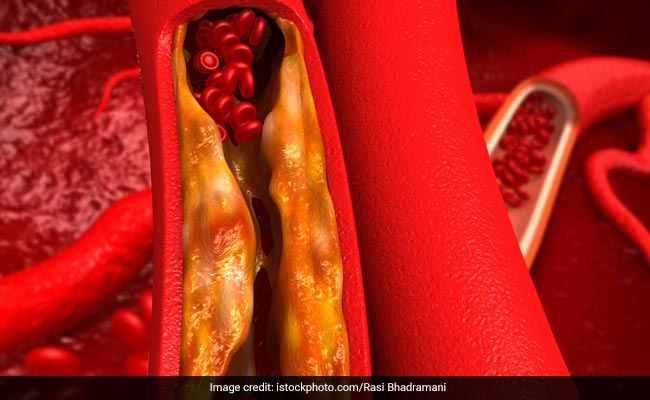 Obesity is a common risk factor for increased cholesterol, heart disease and diabetes