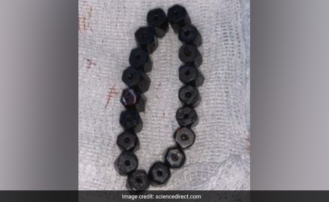 4 साल के बच्चे के पेट में मिला मैग्नेटिक ब्रेसलेट, एक्सरे देख डॉक्टर्स रह गए हैरान!