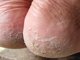 सर्दियों में फटने लगी हैं एड़ियां तो घर पर बना लें यह क्रीम, Cracked Feet की नहीं होगी दिक्कत सर्दियों में फटने लगी हैं एड़ियां तो घर पर बना लें यह क्रीम, Cracked Feet की नहीं होगी दिक्कत