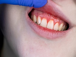 मसूड़ो से बहने लगा है खून तो आजमाकर देख लीजिए ये 5 उपाय, Gum Bleeding से मिल जाएगा छुटकारा  मसूड़ो से बहने लगा है खून तो आजमाकर देख लीजिए ये 5 उपाय, Gum Bleeding से मिल जाएगा छुटकारा