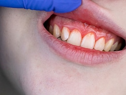 Gum Bleeding: क्या आपके भी मसूड़ों से आता है खून तो डाइट में शामिल करें ये 6 चीजें, कुछ ही दिनों में दिखने लगेगा असर... Gum Bleeding: क्या आपके भी मसूड़ों से आता है खून तो डाइट में शामिल करें ये 6 चीजें, कुछ ही दिनों में दिखने लगेगा असर...