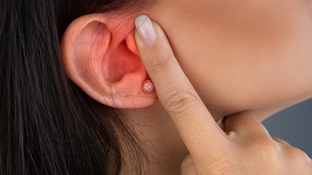 The Valsalva manoeuver is a simple technique to regulate ear pressure