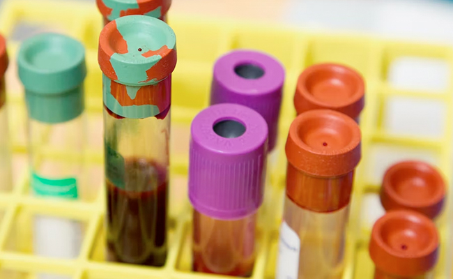 Your Blood Type May Predict Your Risk Of Having A Stroke Before 60, Says Study