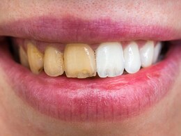 पीले दांत तुरंत मोतियों की तरह लगेंगे चमकने, बेकिंग सोडा में मिलाकर दांतो पर लगाएं ये एक चीज, तुरंत दिखेगा असर पीले दांत तुरंत मोतियों की तरह लगेंगे चमकने, बेकिंग सोडा में मिलाकर दांतो पर लगाएं ये एक चीज, तुरंत दिखेगा असर