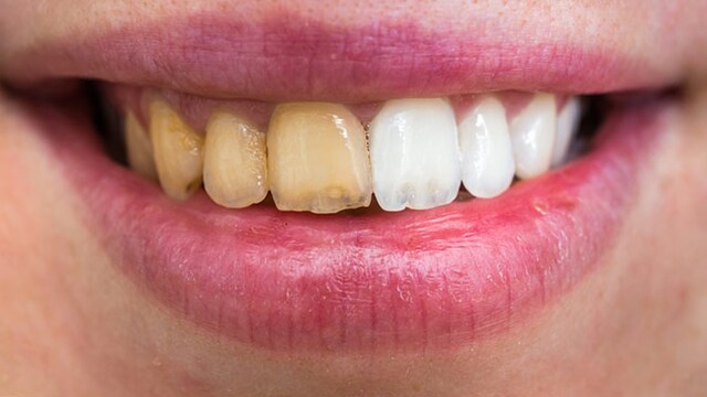 Following a proper dental routine ensures your teeth stay clean, white and infection-free