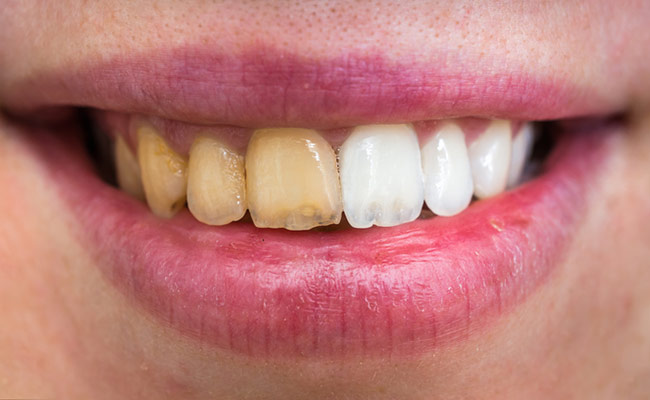 Following a proper dental routine ensures your teeth stay clean, white and infection-free