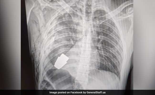 Ukrainian Surgeon Removes Live Grenade From Soldier's Chest