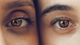 Try These Home Remedies To Stop Dark Circles