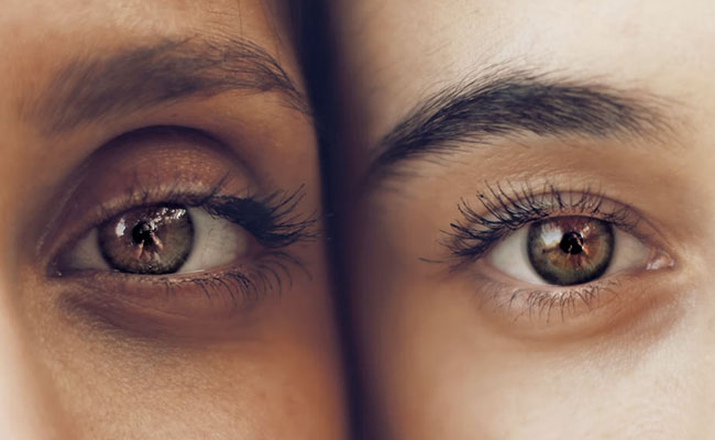 Try These Home Remedies To Stop Dark Circles