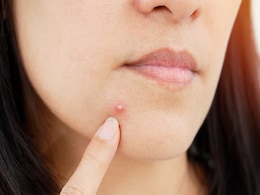 Skincare: What Are Blind Pimples? 7 Tips To Get Rid Of Them Skincare: What Are Blind Pimples? 7 Tips To Get Rid Of Them
