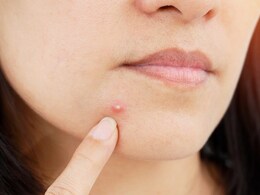 इन 5 विटामिन की कमी से चेहरे पर निकल आते हैं पिंपल्स, यहां जानें