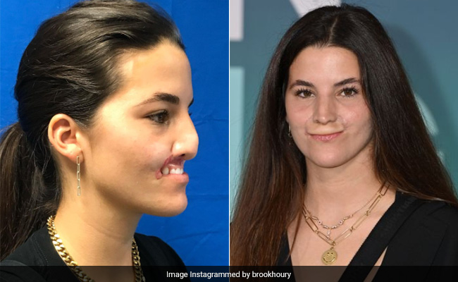 US Model Who Lost Her Lip In Dog Attack Shares Pics Of Transformation