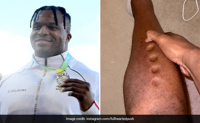 Olympian Lawrence Okoye Shares Playdough-Like Legs After Scary Diagnosis