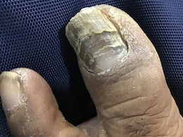 Nail care tips : क्या आपके नाखूनों में फंगस ने बना ली है जगह तो अपनाएं घरेलू उपाय, मिल जाएगा निजात Nail care tips : क्या आपके नाखूनों में फंगस ने बना ली है जगह तो अपनाएं घरेलू उपाय, मिल जाएगा निजात