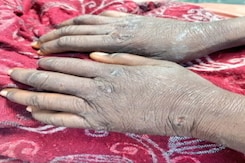 13-Year-Old Help Brutally Thrashed, Tortured By Gurugram Couple, Rescued 13-Year-Old Help Brutally Thrashed, Tortured By Gurugram Couple, Rescued