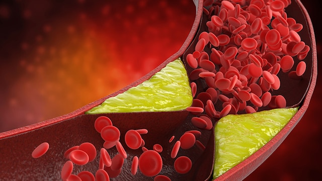 High LDL levels can increase your risk of cardiovascular diseases
