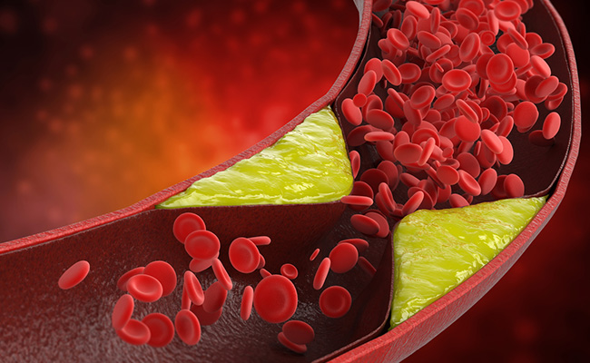 High LDL levels can increase your risk of cardiovascular diseases