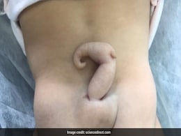 Baby Girl With 6-Centimetre Tail Born In Brazil Baby Girl With 6-Centimetre Tail Born In Brazil