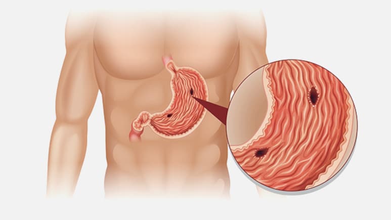 पेट में अल्सर हो गया है? आयुर्वेद के रामबाण नुस्&zwj;खे करेंगे मदद