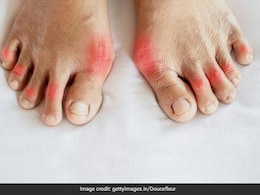 बस इन फूड्स को खाकर चुटकियों में घटा सकते हैं High Uric Acid, कर लीजिए डाइट में शामिल