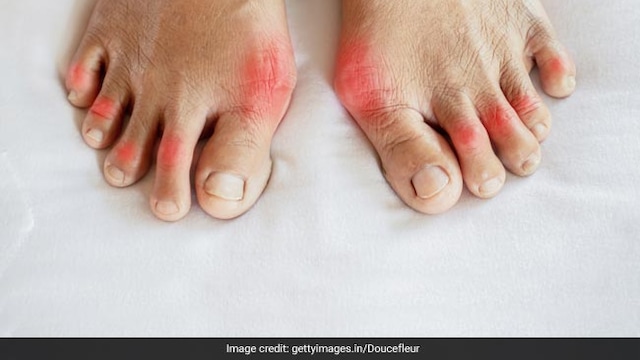 High uric acid can affect your body in several ways