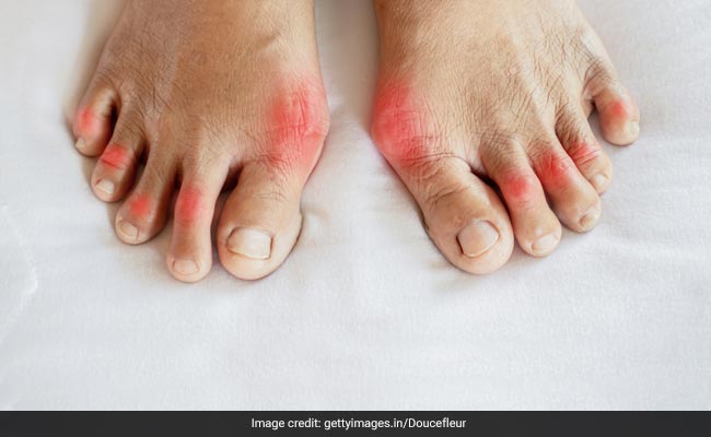 High uric acid can affect your body in several ways
