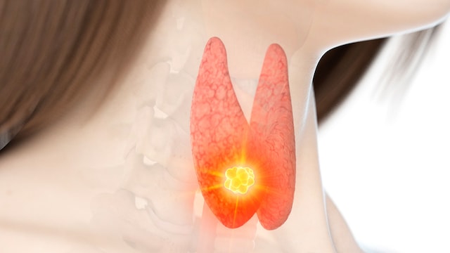 This diet changes can help in managing symptoms associated with hypothyroidism