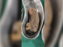Large Hair Mass Removed From Stomach Of Mumbai Girl With Rare Condition Large Hair Mass Removed From Stomach Of Mumbai Girl With Rare Condition