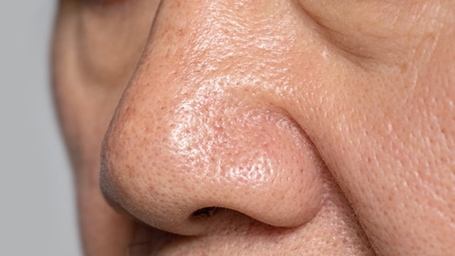 Poor skin care routine may cause enlarged pores along with other factors