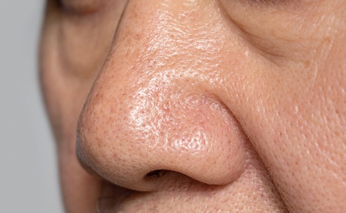 Poor skin care routine may cause enlarged pores along with other factors