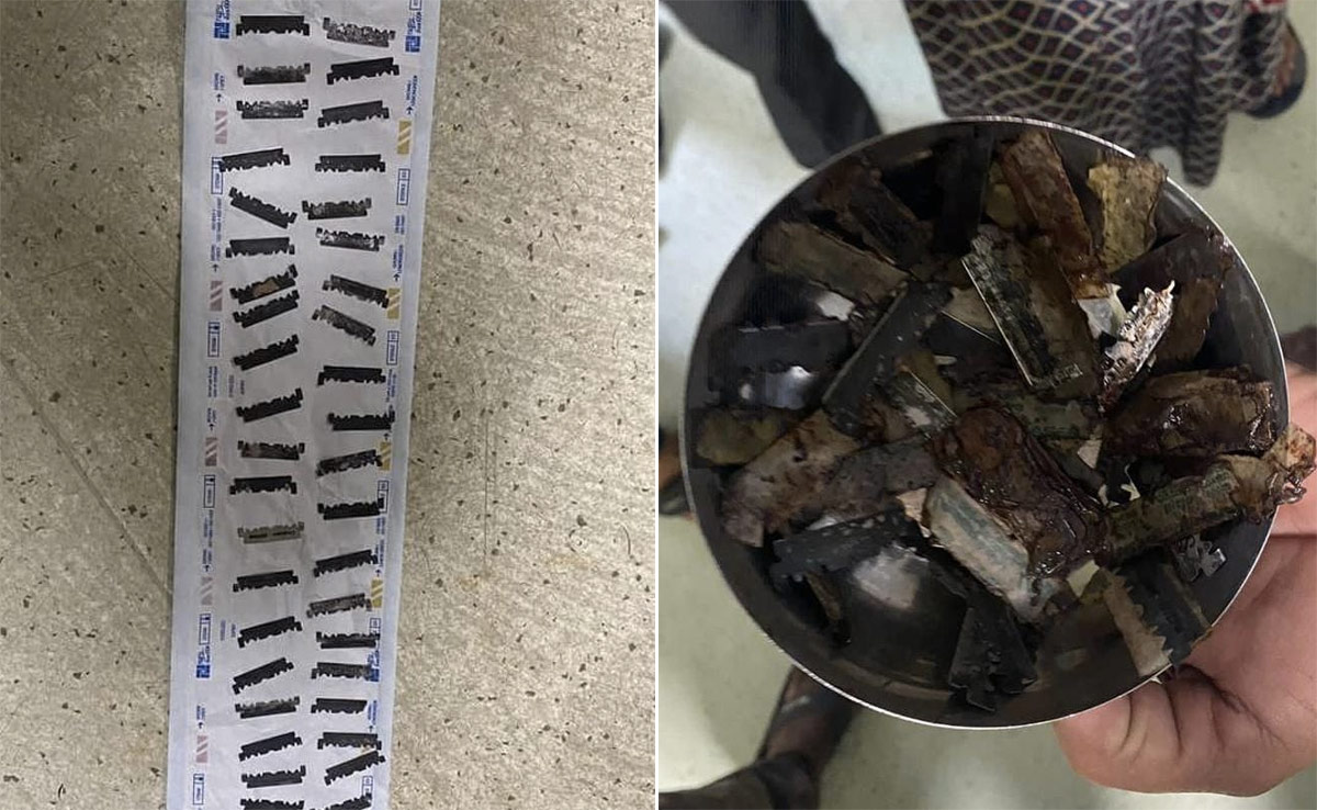 56 Pieces Of Razor Blades Found In Man's Stomach During Surgery In Rajasthan