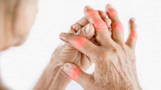 Uric Acid Effects: High uric acid can result in permanent joint damage if left untreated.