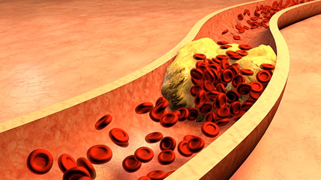 Poor Cholesterol: These 8 Simple Tips Can Help Bring Down High Cholesterol Naturally
