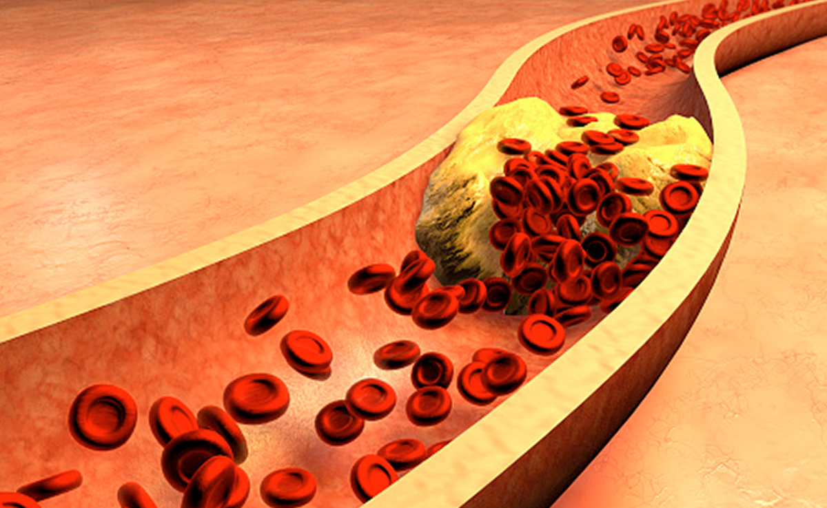 Poor Cholesterol: These 8 Simple Tips Can Help Bring Down High Cholesterol Naturally