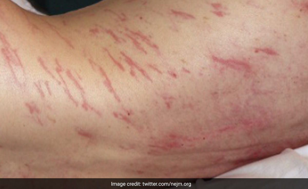 Sewage Worker In Spain Shows Up At Hospital With Worms Slithering Under His Skin